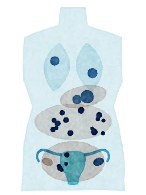 Stage IV: spread to the liver and lungs